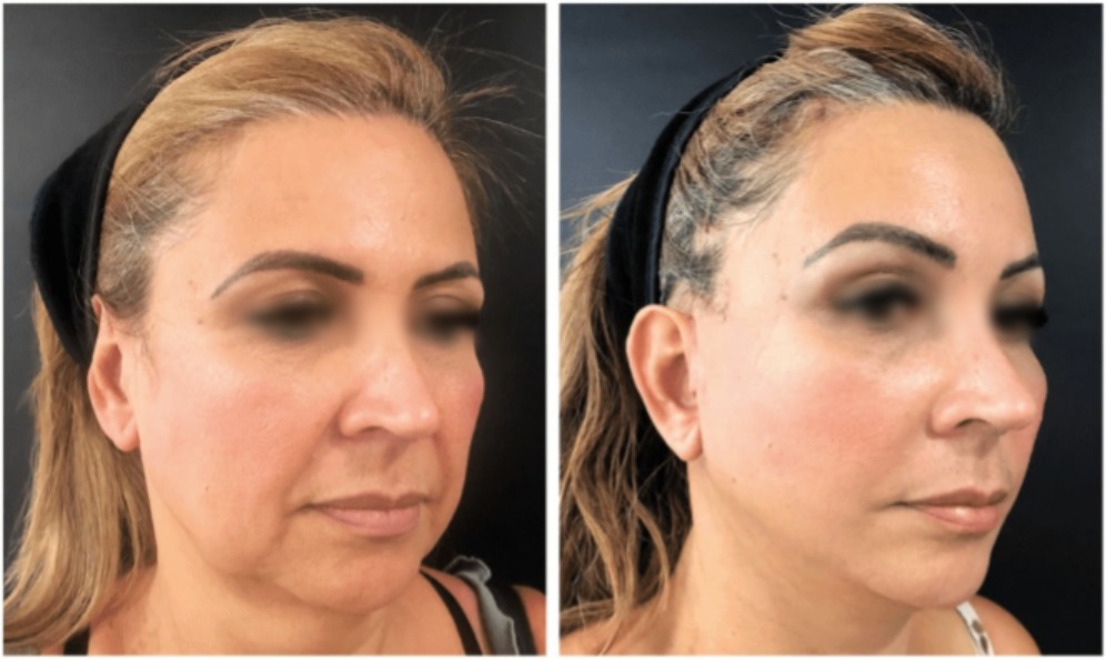 Lifting facial caso 5 — antes y después